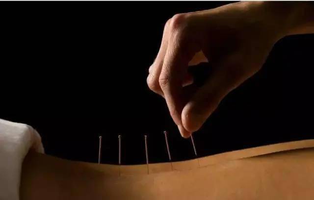 平衡針灸最新視頻，現(xiàn)代應(yīng)用探索針灸藝術(shù)的新境界