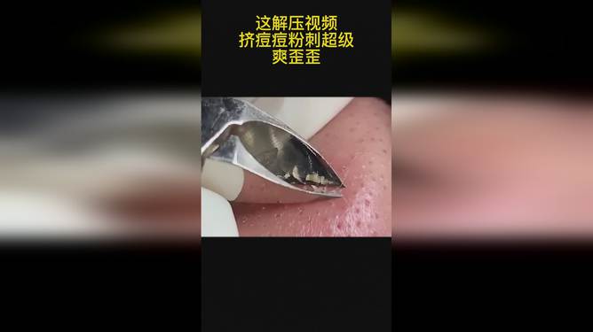 最新擠膿包視頻，見證變化的力量，自信與成就感的誕生之地