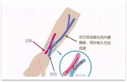 靜脈瘺最新資訊，掌握最前沿的健康信息
